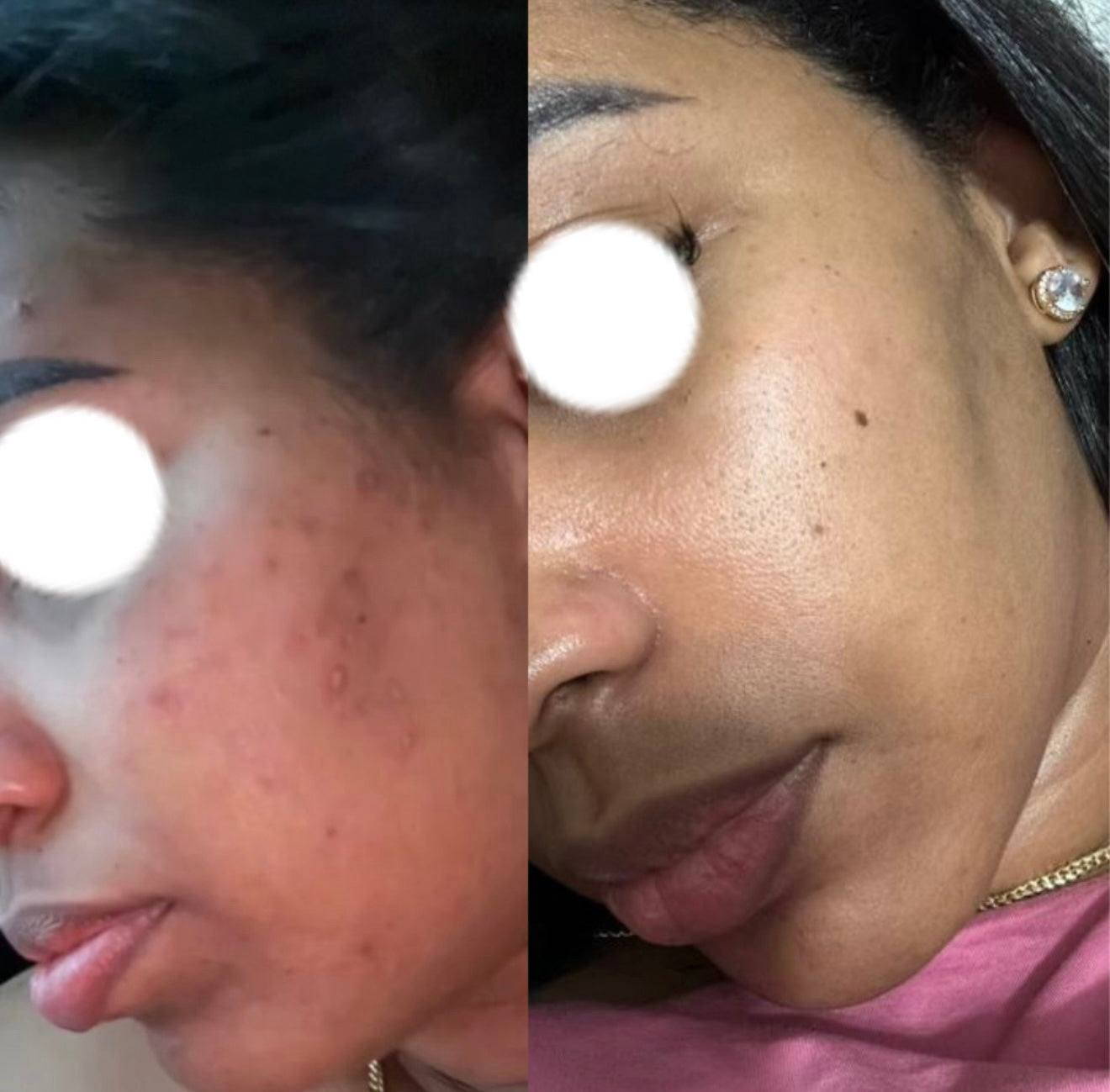 CHEMICAL PEELING ( 3 SESSIONS )
