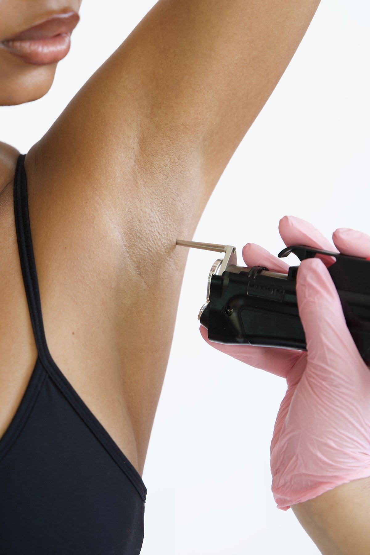 Laser hair removal treatment at Muse Skin Lab in Astoria, Queens