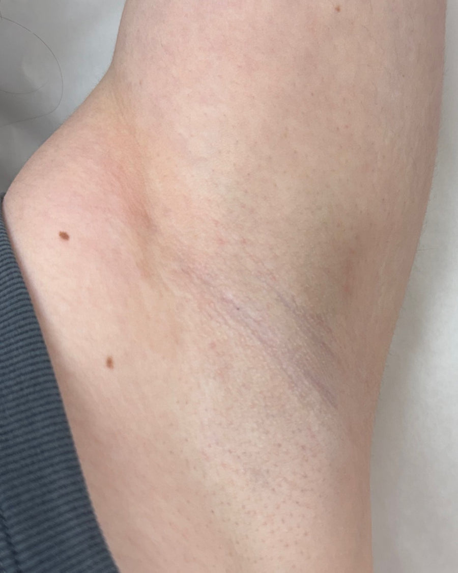 Underarms after laser hair removal