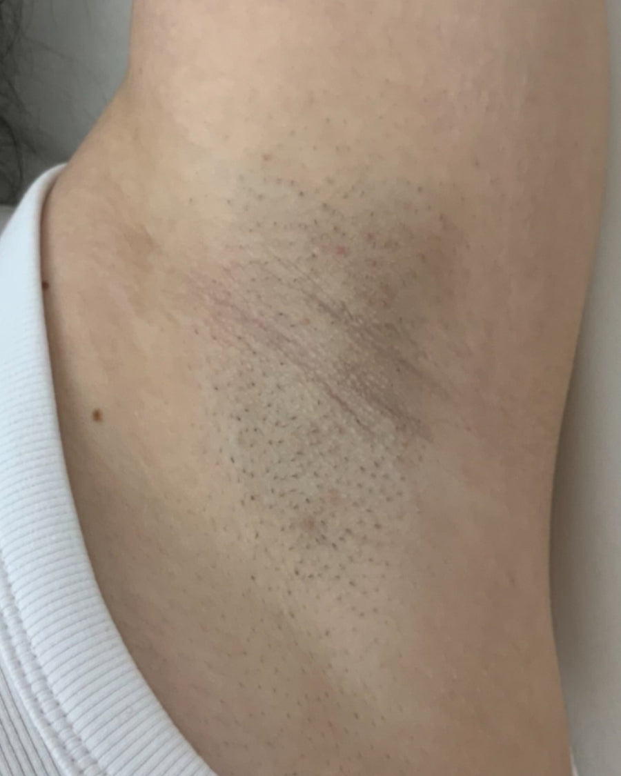 Underarms before laser hair removal