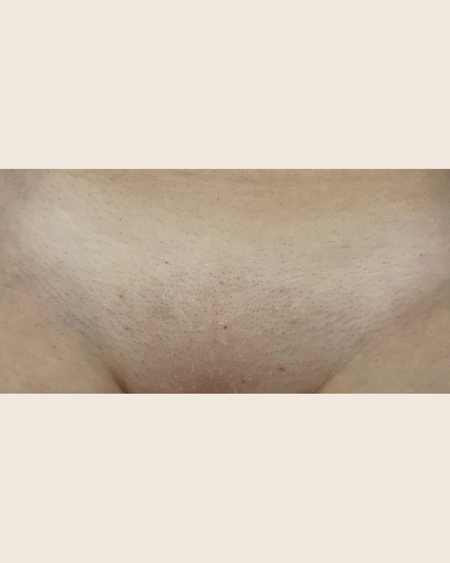 Brazilian after laser hair removal
