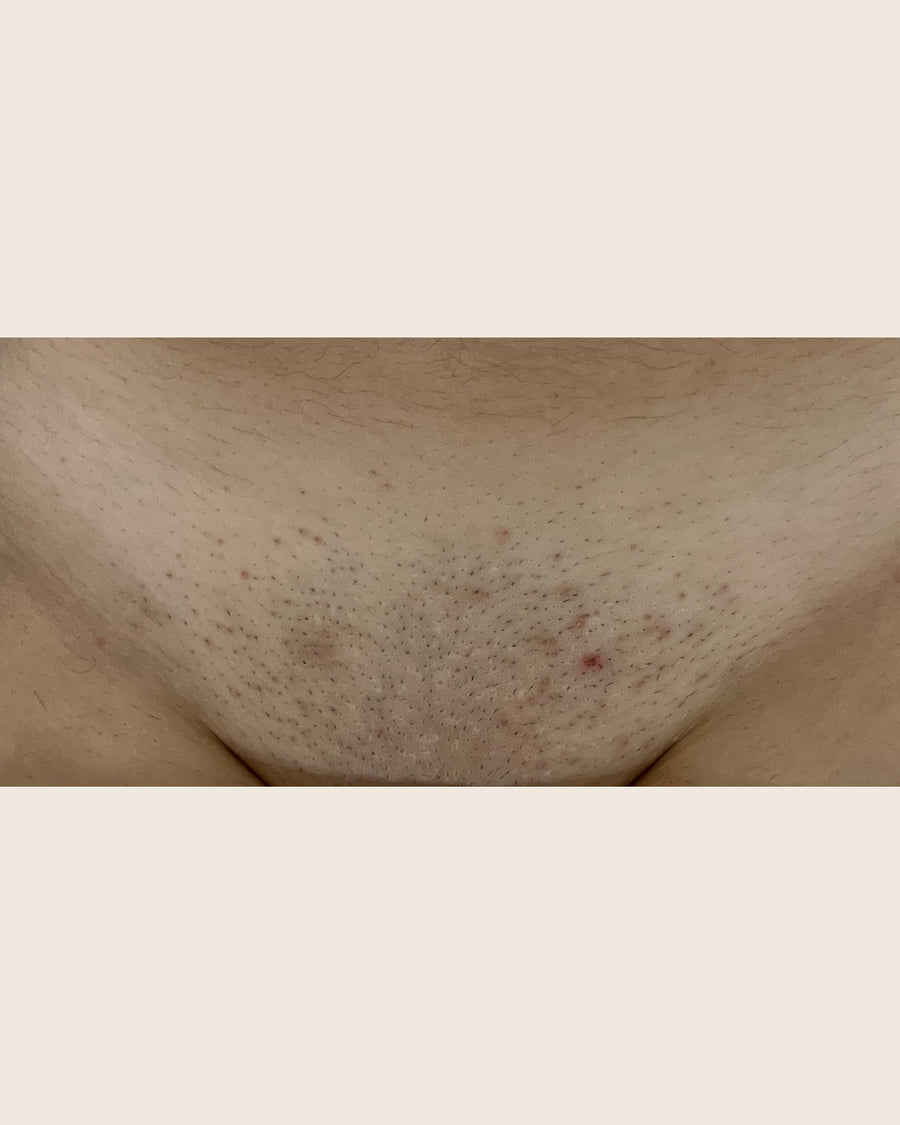 Brazilian before laser hair removal